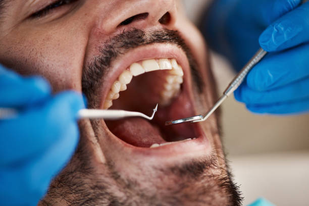Best Emergency Dental Care for Broken or Chipped Teeth in Moncks Corner, SC